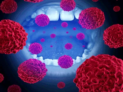 Mouth Cancer Treatment In Asia